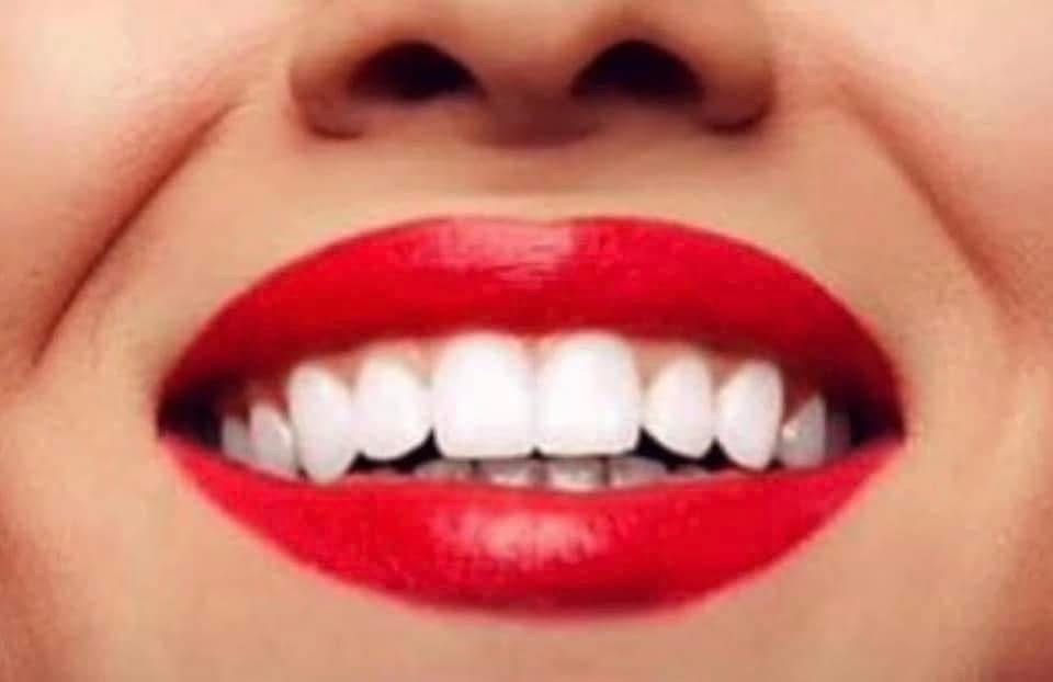 Deluxe Teeth Whitening 